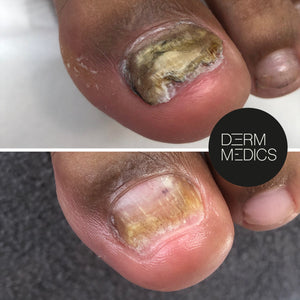 Voor de kalknagelbehandeling: een aangetaste nagel met verkleuring en verdikking." "Na de kalknagelbehandeling: een gezonde nagel zonder verkleuring en duidelijke verbetering."