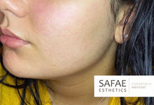 Charger l&#39;image dans la galerie, TCA PEEL SKIN KIT IMPURITIES
