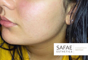 TCA PEEL SKIN KIT IMPURITIES