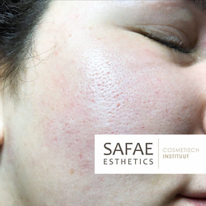 TCA PEEL SKIN KIT IMPURITIES